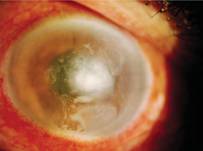 Figura 8.10. úlcera corneal por Pseudonomas en un paciente con lentes de contactos (LC).