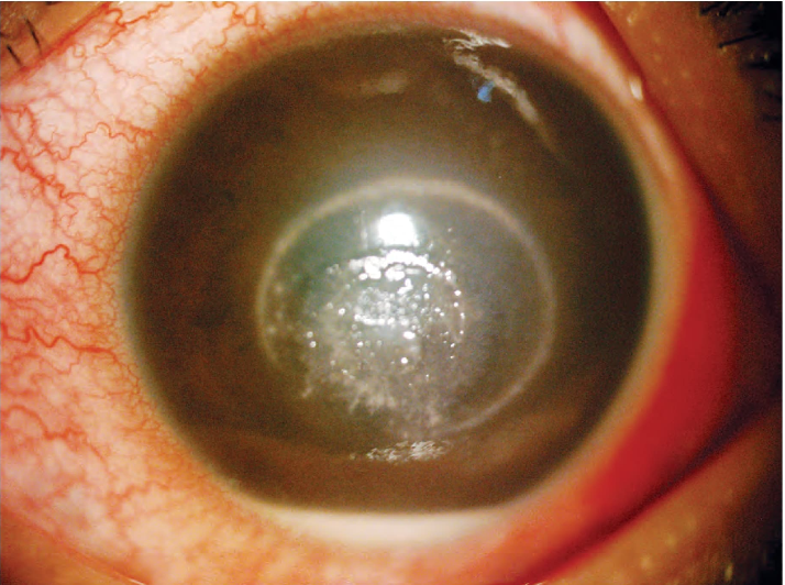 Figura 8.11. Queratitis fúngica con anillo inmunitario en un paciente con lentes de contacto (LC).