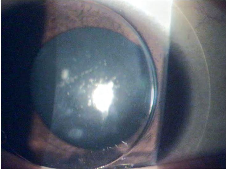 Figura 8.2. Lente Piggyback que muestra un lente rígido permeable al gas (RGP) colocado sobre un lente de contacto blando en pacientes intolerantes a los lentes rígidos.