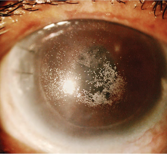 Figura 8.6. Depósitos de lentes de contacto observados en un paciente con uso prolongado de lentes.