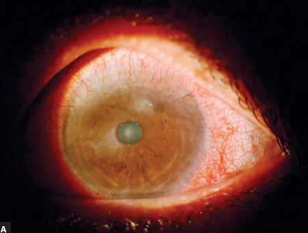 Figura 8.8 A y B Micropannus inducidos por lentes de contacto con deficiencia de células madre limbares (LSCD) observado en (A) iluminación difusa y (B) tinción con fluoresceína.