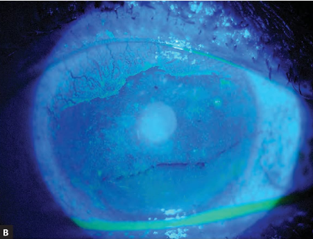 Figura 8.8 A y B Micropannus inducidos por lentes de contacto con deficiencia de células madre limbares (LSCD) observado en (A) iluminación difusa y (B) tinción con fluoresceína.