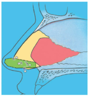 Figura 38.2: Injerto de extensión septal: pasos 1 a 4