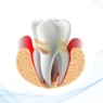 Periodontitis inducida por biopelícula dental