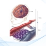 Nuevos enfoques para la enfermedad ateroesclerótica intracraneal 