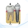 Implantes y dientes: un desafío en la planificación