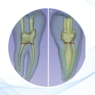 El láser transforma la endodoncia